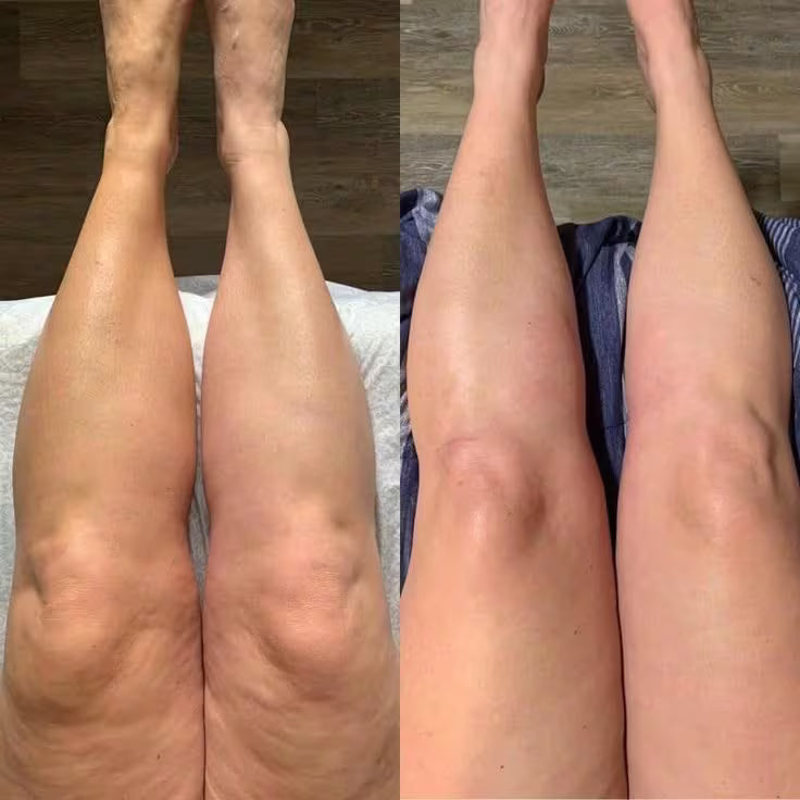 Avant/après Stéphanie C. — jambes dégonflées avec Lyphéa